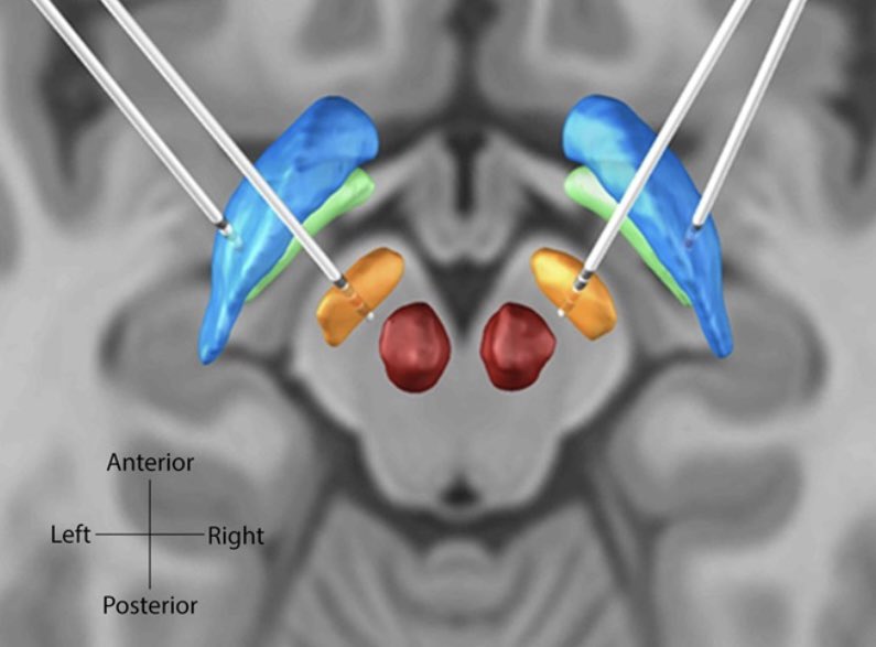 Prelim data from <a href="/Dukeneurosurg/">Duke Neurosurgery</a> <a href="/Duke_Neurology/">Duke Neurology</a>! We evaluated the clinical benefit of stimulating a combination of STN and GP leads. ⬆️ decrease in OFF-medication UPDRS, ⬆️ reduction in STN beta-oscillations with combined stim &amp; potential for #adaptivestim tinyurl.com/5n7uk89p