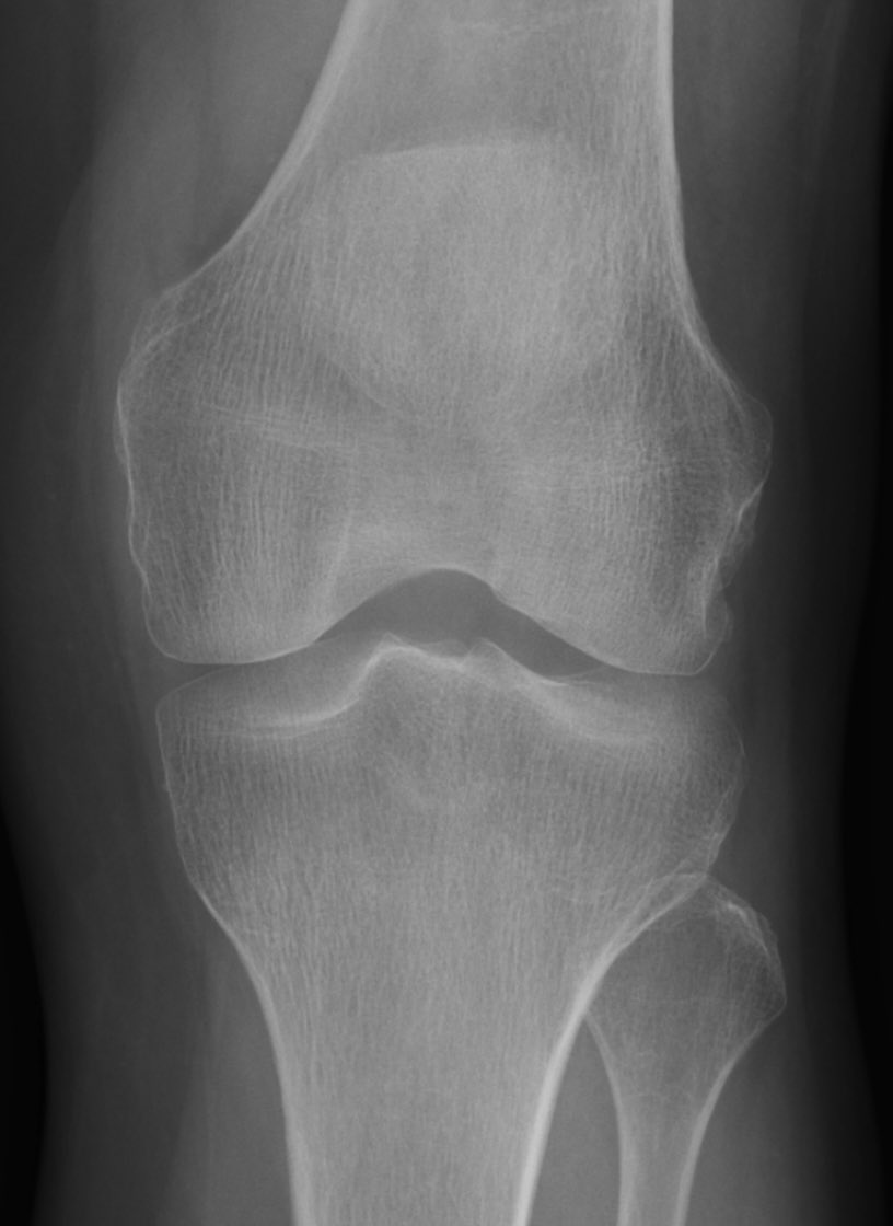 emin_adin's tweet photo. Soldaki diz 56 yaşındaki birinin, sağdaki diz 85 yaşındaki birinin. Soldaki diz osteoartritten (kireçlenme) perişan  olmuş vaziyette, sağdaki diz 30 yaşındaki birinin diziyle neredeyse aynı güzellikte. Dizlerinize iyi bakın, ilerde çok lazım olurlar. https://t.co/u1JRFW8Khf