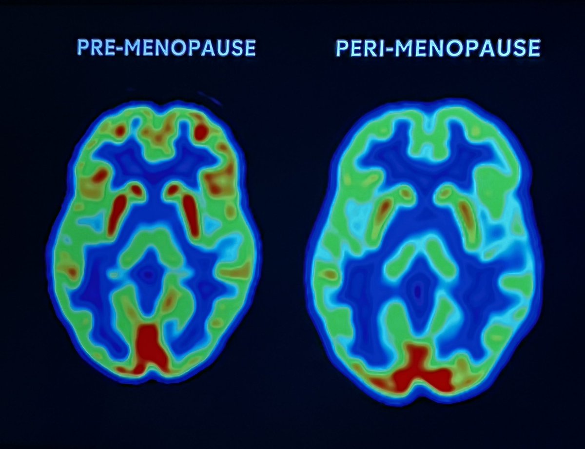Dr Louise Newson (@drlouisenewson) on Twitter photo Oestrogen and testosterone are important for female brain function - this picture is so relevant and important <a href="/dr_mosconi/">Dr. Lisa Mosconi</a> <a href="/ThisisDavina/">Davina McCall</a> #DavinaMenopause Oestrogen and testosterone are important for female brain function - this picture is so relevant and important <a href="/dr_mosconi/">Dr. Lisa Mosconi</a> <a href="/ThisisDavina/">Davina McCall</a> #DavinaMenopause