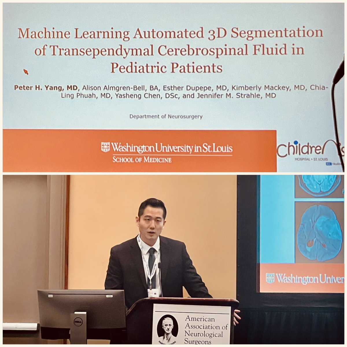 Jennifer Strahle, MD (@strahlemd) on Twitter photo Another great talk from <a href="/PeterHYangMD/">Peter H Yang</a>- AI-based methods to analyze brain regions/pathologies that permit CSF migration across the ependyma. In collaboration with <a href="/WashUNeurology/">WashU Medicine Neurology</a>. <a href="/AANSNeuro/">AANS</a> <a href="/WashUNeurosurg/">WashU Med Taylor Family Department of Neurosurgery</a> #AANS2022 #csf #development Another great talk from <a href="/PeterHYangMD/">Peter H Yang</a>- AI-based methods to analyze brain regions/pathologies that permit CSF migration across the ependyma. In collaboration with <a href="/WashUNeurology/">WashU Medicine Neurology</a>. <a href="/AANSNeuro/">AANS</a> <a href="/WashUNeurosurg/">WashU Med Taylor Family Department of Neurosurgery</a> #AANS2022 #csf #development
