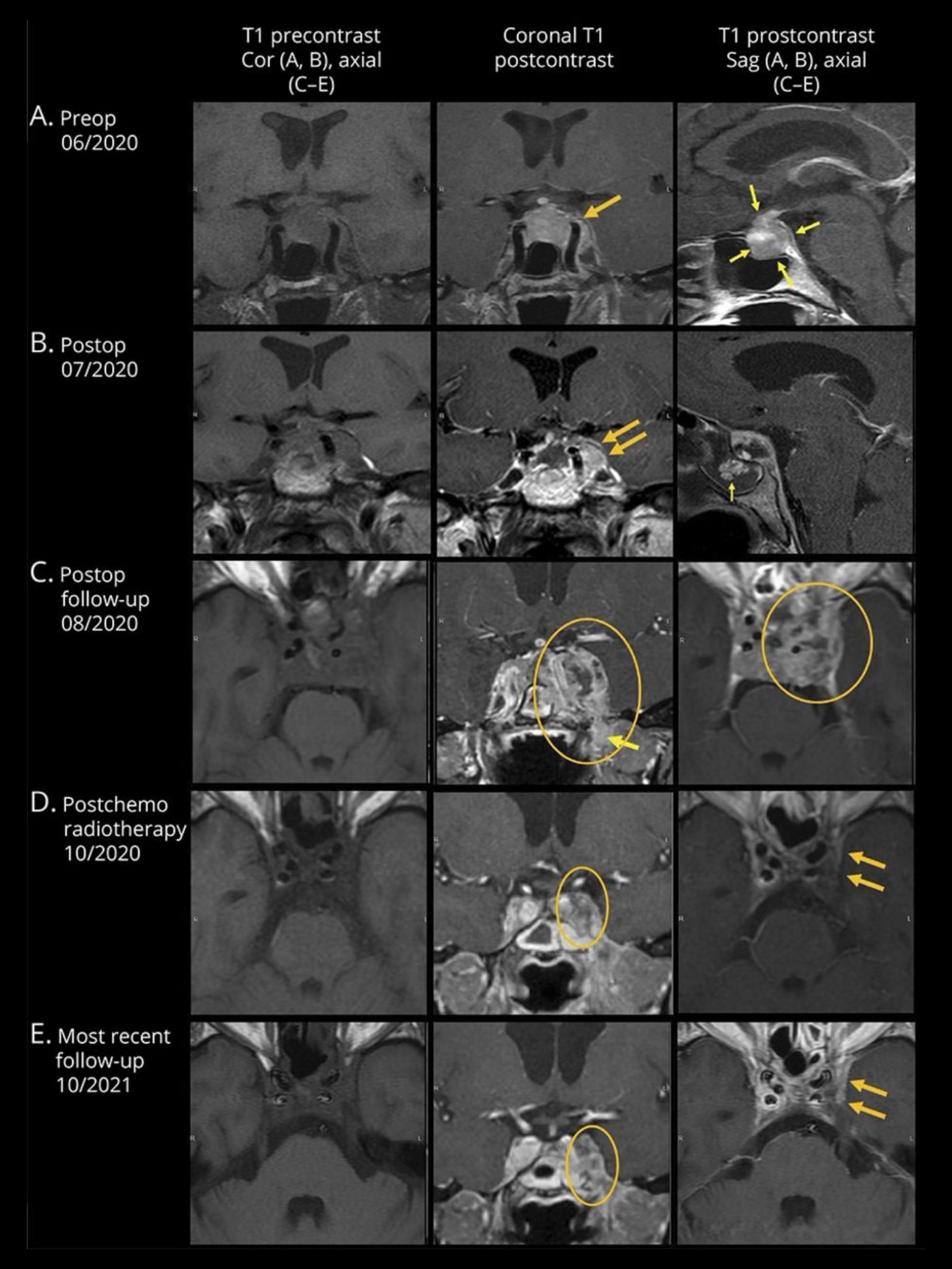 Neurology Journal on Twitter "Pearls & Oysters Pivoting Treatment Regimens of Pediatric