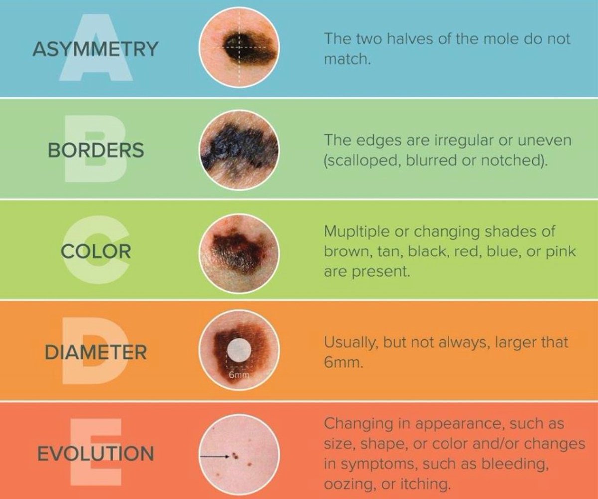 UtahCancr's tweet photo. A change in your skin is the most common sign of skin cancer. This could be a new growth, a sore that doesn’t heal, or a change in a mole. 

A simple way to remember common characteristics of melanomas is the A-B-C-D-Es of skin cancer. https://t.co/kRGUsXz1T6
