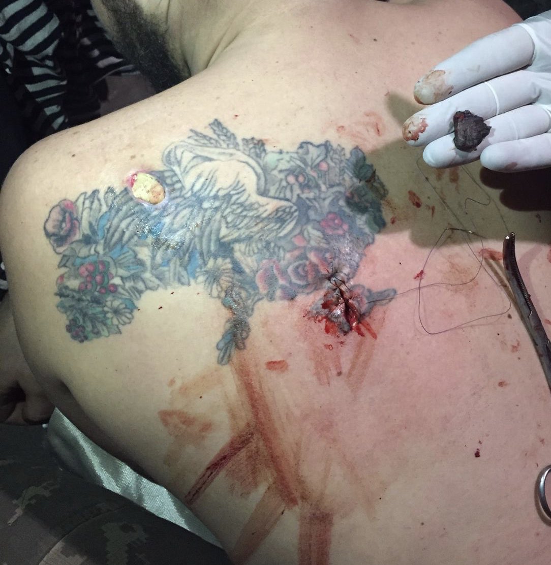 Wounded Ukraine from 🇺🇦defender at Azovstal. A shrapnel hit his friend right in the tattooed Crimea that has been occupied by Russia since 2014.