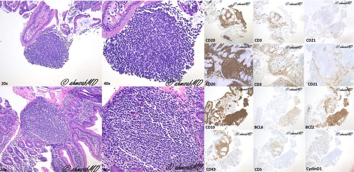 Duodenal-type follicular lymphoma!
- Usually low-grade
- Germinal center markers positive
- CD21: accentuated at the periphery of germinal center follicles
- Localized to GI tract than nodal

#medtwitter #PathTwitter #pathology #Path #path2path #hemepath #pathoutpic #GIpath