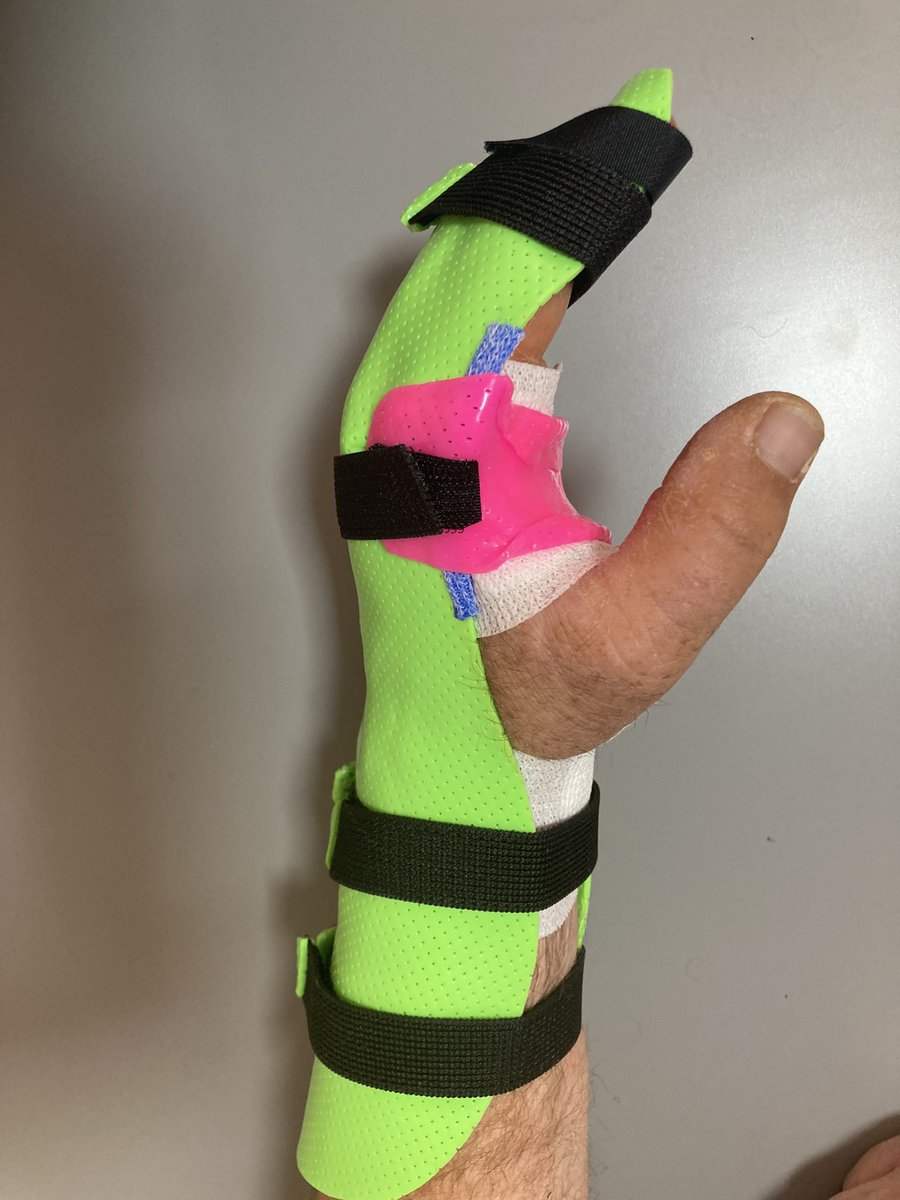 HandOrthosis's tweet photo. Protegiendo la sutura. Poniendo color y ligereza es más fácil comenzar la movilización precoz! 👇🏼 https://t.co/WN9e7ga3ak