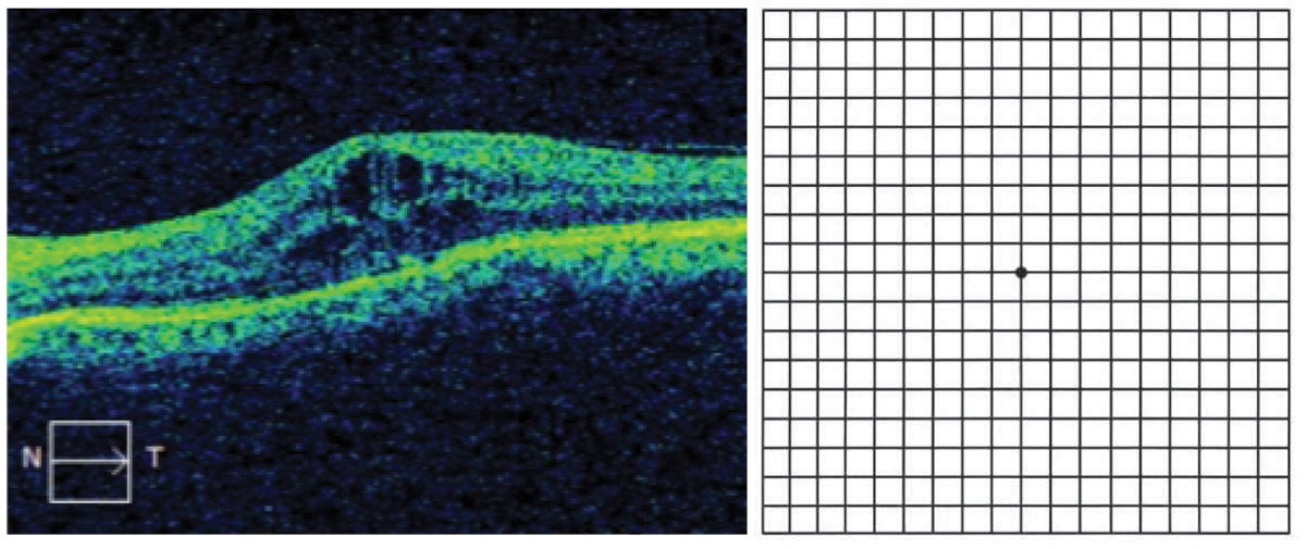 revoptom's tweet image. "All Squared Away"—While often overlooked, the Amsler grid can help distinguish macular diseases from other ocular conditions.
reviewofoptometry.com/article/all-sq…
#news #optometry #eyecare #macula #retina
