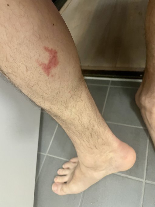 Pro tip: don’t go dancing with a leaking bottle of poppers in your socks. That’s gonna be a burn :( https://t
