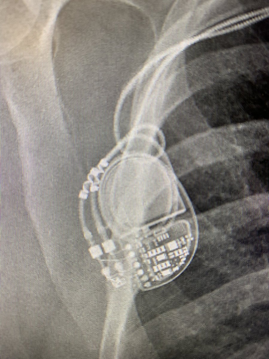 Gen Change from today. I noticed the bright material wrapped around both leads and wasn’t sure what it was. Clearly not the suture sleeves. A quick Google search gave me the answer. Do you know what they are without Googling?#EPeeps