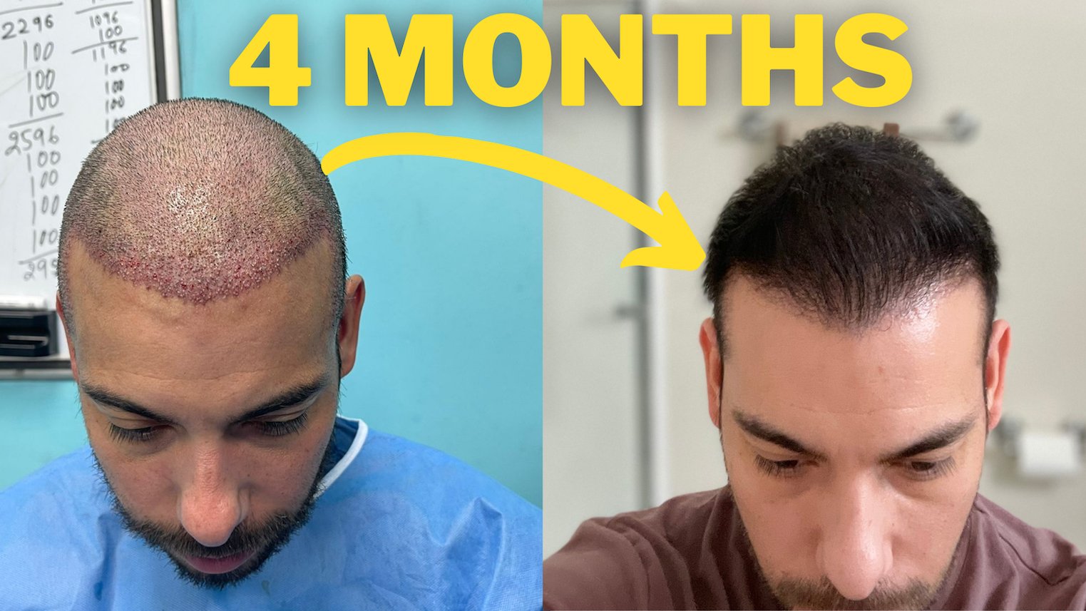 Hair Transplant Network on Twitter: Hair Transplant Network on Twitter: