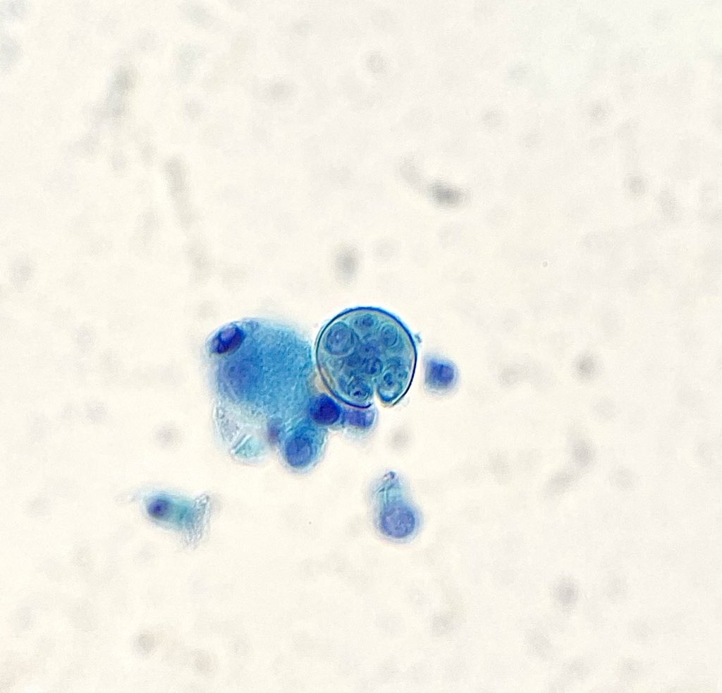 Bronchoalveolar lavage containing dimorphic fungi of Coccidioides species. A spherule containing endospores is seen next to a macrophage. #PathTwitter #PathArt #IDTwitter #Microbiology #CytoPath #Cytology #Fungi