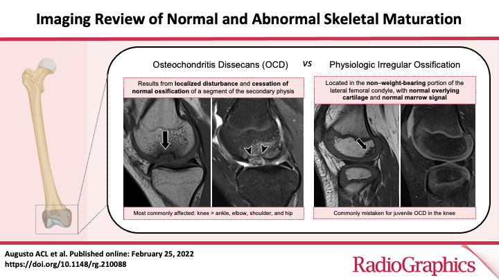 RadG_Editor's tweet photo. Imaging Review of Normal and Abnormal Skeletal Maturation
Augusto ACL et al
Pediatric Imaging
https://t.co/y1iTuxs0Fk 

@aclaugusto
@dyannotdiane
@andreaihara
#RGphx
15/19 https://t.co/y0oQr0CCQ0