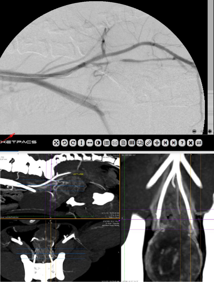 Chris Thomson (@christhomson3) on Twitter photo Another dog #PAE in the books! Neutered 10kg dog with prostate carcinoma, treated with embo prior to RT. #irad improving lives for pets and people!! <a href="/SIRspecialists/">Society of Interventional Radiology</a> <a href="/SandeepBaglaMD/">Sandeep Bagla MD</a> <a href="/AriIsaacsonMD/">Ari Isaacson</a> Another dog #PAE in the books! Neutered 10kg dog with prostate carcinoma, treated with embo prior to RT. #irad improving lives for pets and people!! <a href="/SIRspecialists/">Society of Interventional Radiology</a> <a href="/SandeepBaglaMD/">Sandeep Bagla MD</a> <a href="/AriIsaacsonMD/">Ari Isaacson</a>