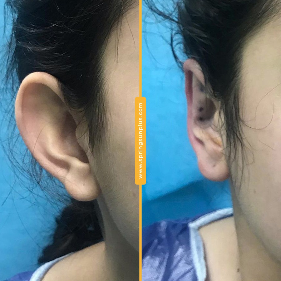 springsunplus's tweet photo. Prominent Ear Surgery (Otoplasty) in Turkey
#earsurgery #prominentearsurgery #earsurgeryturkey #otoplasty #springsunplus #turkey #healthtourism https://t.co/NrUlnb5gPD