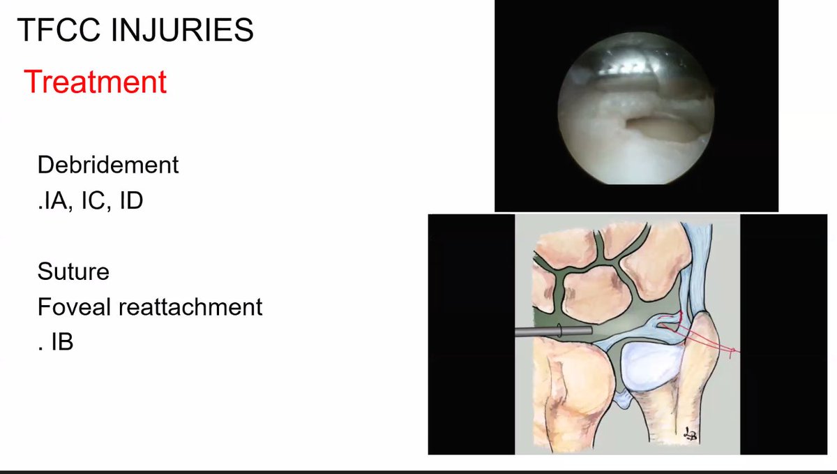 Prosiguiendo con el #Modul08 de #EESS, el Dr. Cristóbal Martínez desde la <a href="/Clinica_Teknon/">Centro Médico Teknon</a> plantea la “Utilidad de la #artroscopia en las #Fracturas de #radio #distal” <a href="/quironsalud/">quirónsalud</a> <a href="/innovacio_csi/">Innovació. Consorci Sanitari Integral</a>