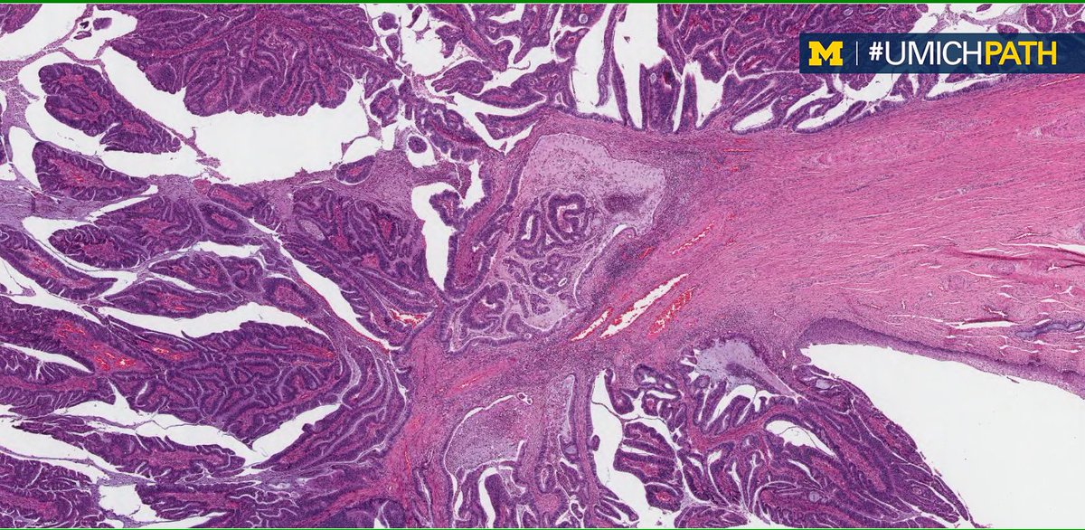 UMichPath's tweet photo. This week's #CaseOfTheWeek is here, sent in by @BatoulAoun1 from #UMichPath.

A 42 y.o. F with a 5.5 cm exophytic cervical mass, underwent a radical hysterectomy with bilateral salpingo-oophorectomy. 

What is your diagnosis? Answer revealed on Friday! #gynpath #pathart https://t.co/PlQs6puoaO