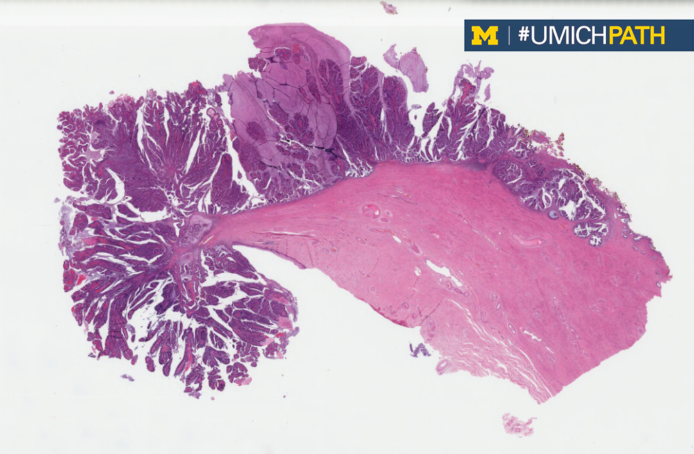 UMichPath's tweet photo. This week's #CaseOfTheWeek is here, sent in by @BatoulAoun1 from #UMichPath.

A 42 y.o. F with a 5.5 cm exophytic cervical mass, underwent a radical hysterectomy with bilateral salpingo-oophorectomy. 

What is your diagnosis? Answer revealed on Friday! #gynpath #pathart https://t.co/PlQs6puoaO