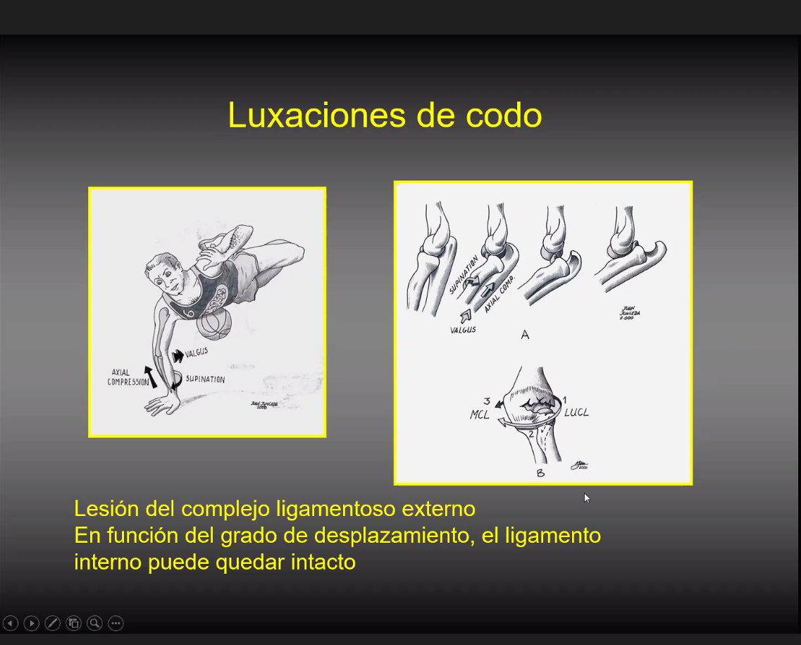 Sobre la “#Luxación de #codo y su #Inestabilidad #postraumática“ nos ilustra el Dr. Xavier Espiga, emérito del <a href="/hospitaldelmar/">Hospital del Mar</a> y miembro del Grup Català d'Estudi del Colze <a href="/sechc_oficial/">SECHC</a> @IMIM_research #biomecanica #olecranon #coronoides