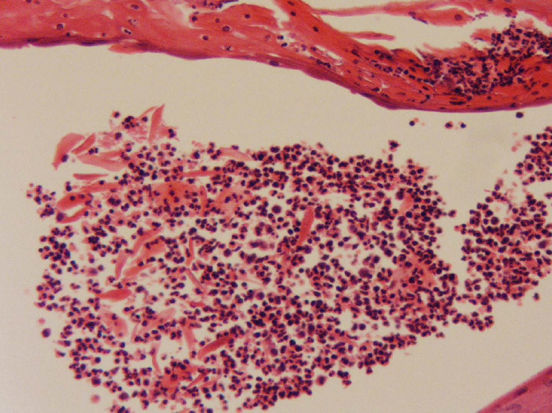 Drmerm's tweet photo. Pustular Psoriasis
#Dermatology #PathTwitter #pathology #MedTwitter #medecine #dermatopath #WebPathology #dermpath #dermatologie #dermatologia #dermtwitter #BSTpath
@WebPathology @JMGardnerMD @Pathoutlines https://t.co/rxHK0PplhS