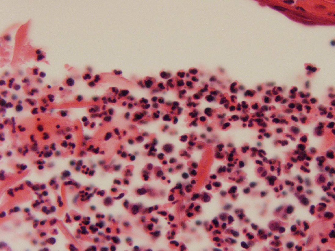 Drmerm's tweet photo. Pustular Psoriasis
#Dermatology #PathTwitter #pathology #MedTwitter #medecine #dermatopath #WebPathology #dermpath #dermatologie #dermatologia #dermtwitter #BSTpath
@WebPathology @JMGardnerMD @Pathoutlines https://t.co/rxHK0PplhS