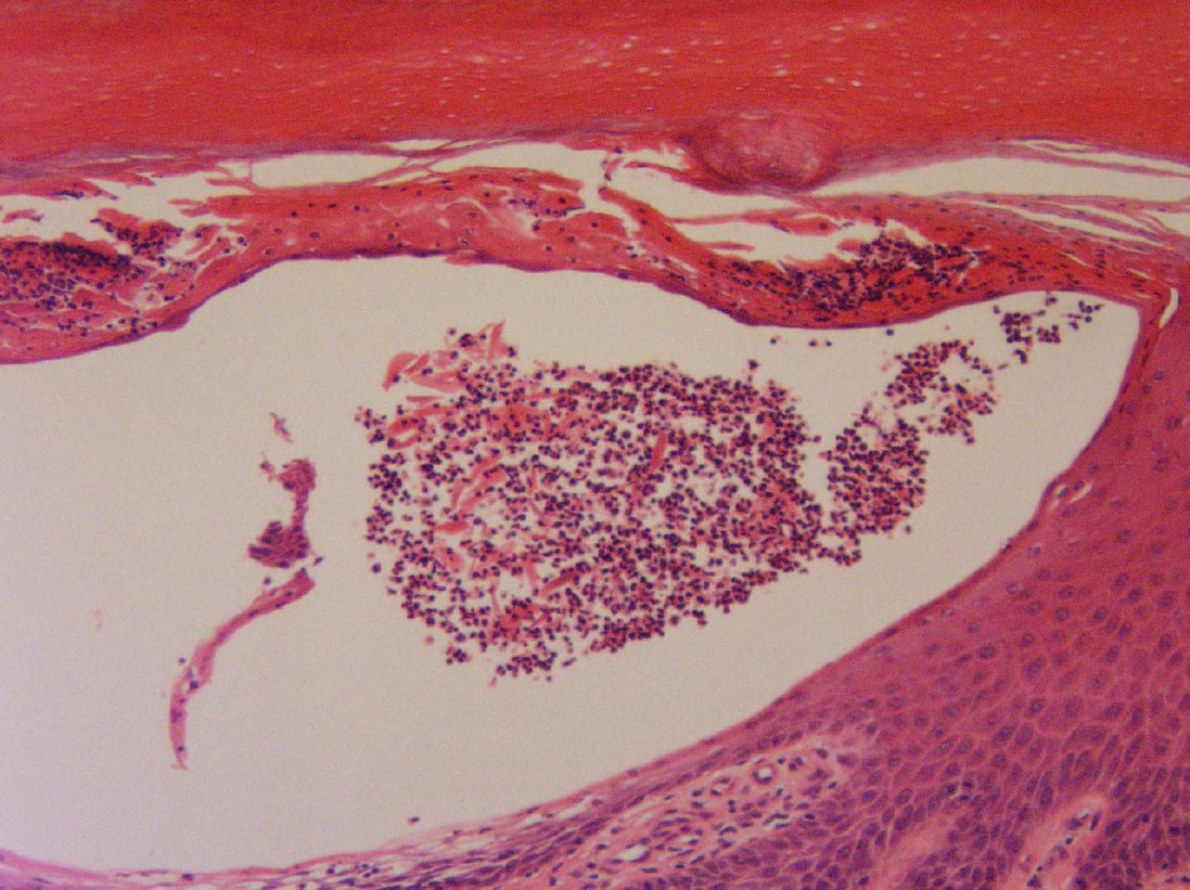 Drmerm's tweet photo. Pustular Psoriasis
#Dermatology #PathTwitter #pathology #MedTwitter #medecine #dermatopath #WebPathology #dermpath #dermatologie #dermatologia #dermtwitter #BSTpath
@WebPathology @JMGardnerMD @Pathoutlines https://t.co/rxHK0PplhS
