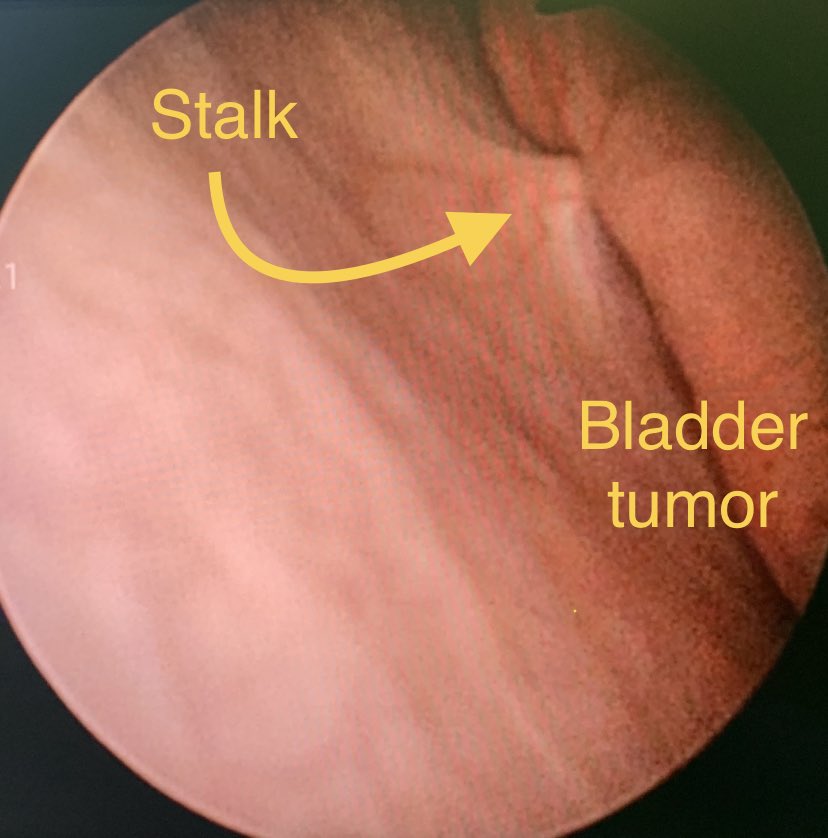 AcademicOner's tweet photo. A remark from today’s case: The stalk of BC consists of fibrous connective tissue, blood vessels,inflammatory cell infiltration and edema. Observation of a stalk may be used to exclude bladder wall invasion (Saito et al. 2000) @itfuroloncology @dresataydin #bladdercancer https://t.co/r3mEumhANU