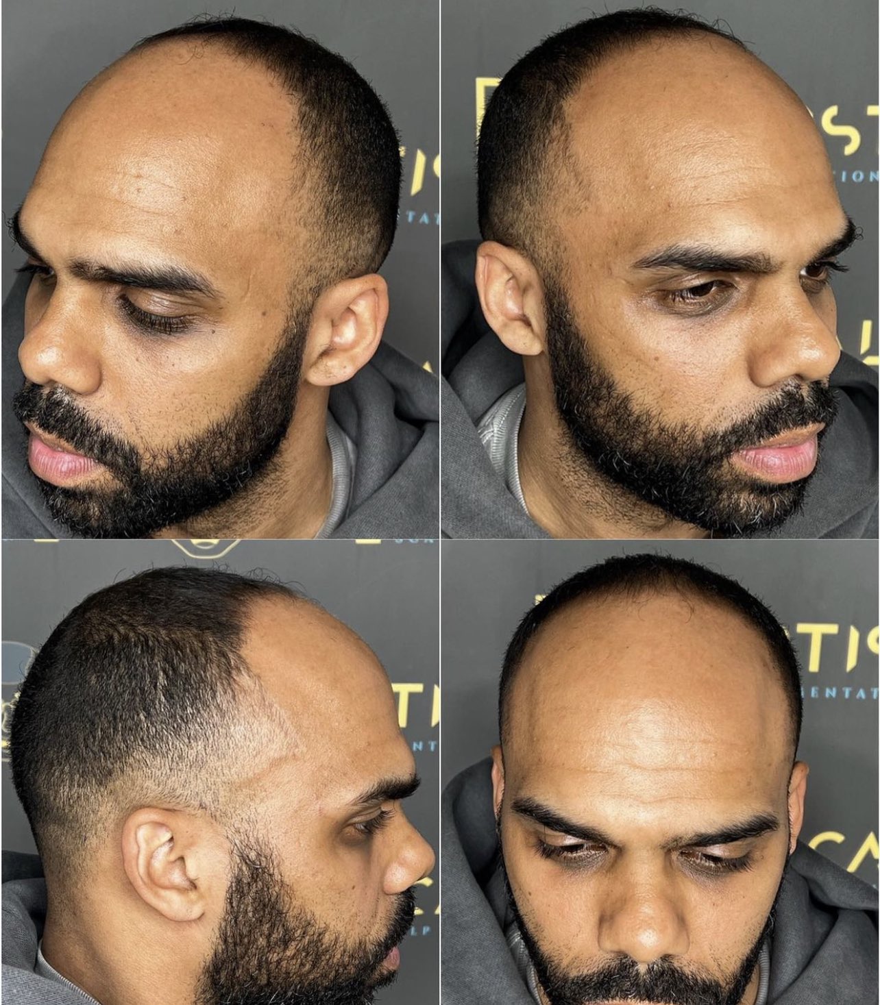 Scalp Micropigmentation in Honolulu, Hawaii | YAMA Studios