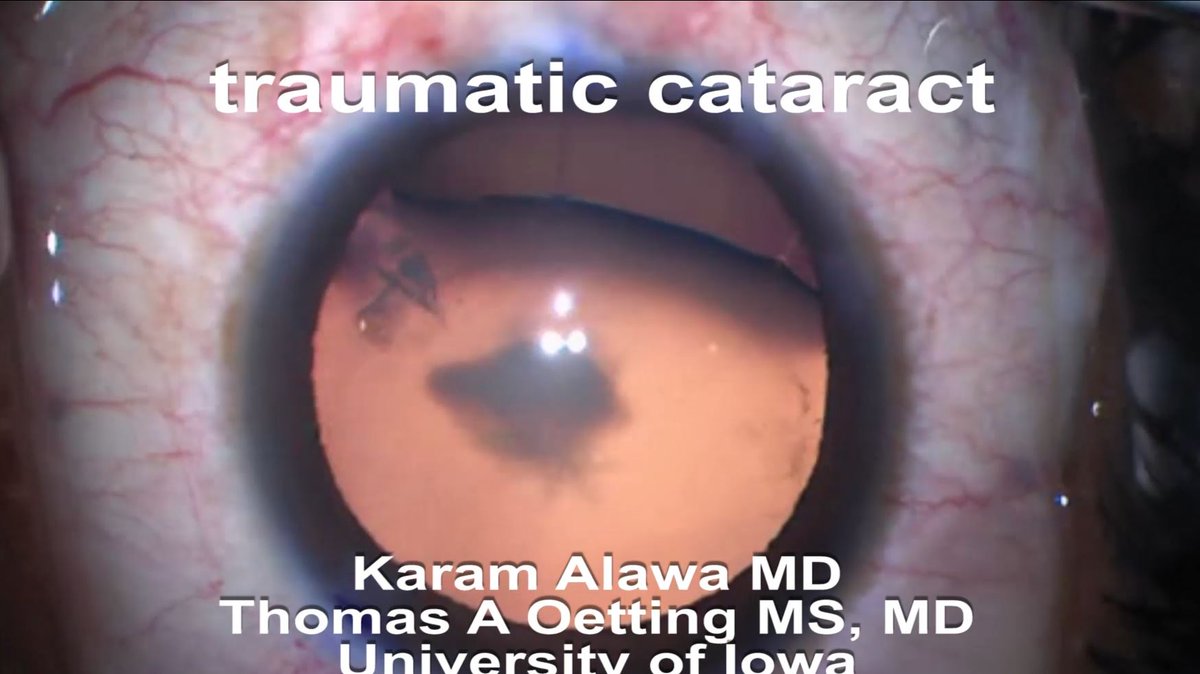 Cool traumatic case by <a href="/uiowaeye/">UIowa Eye</a> chief resident Karam Alawa.  He uses Sideways Arshinoff, early CTR, gortex sutured CTS, and places toric IOL.  #Ophthalmology #Ophthotwitter  youtu.be/RCCUAu7wUB4