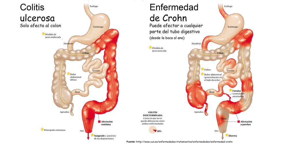 Sintomas del colitis nervioso