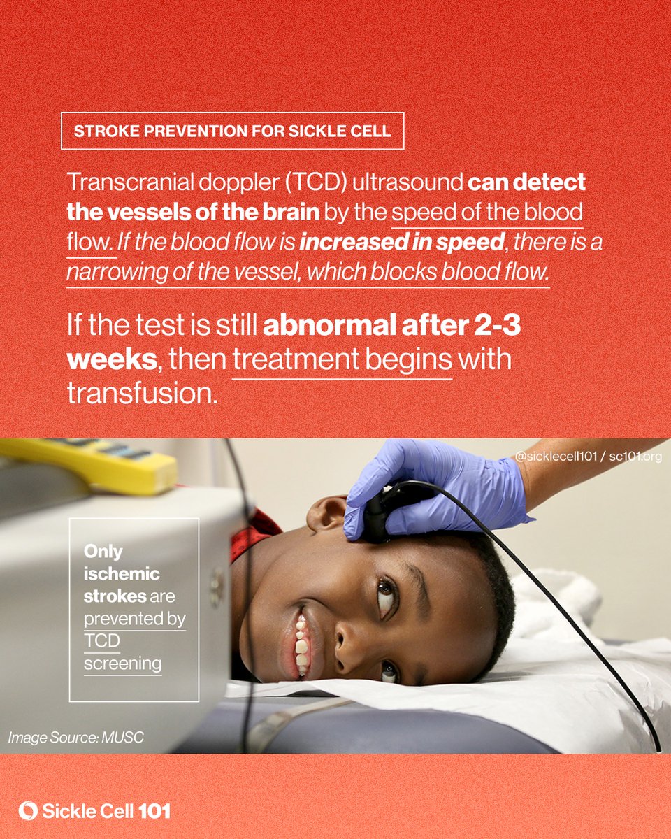 sicklecell101's tweet image. Did you know by the age of 40 years 20% of people who have #sicklecell anemia (SS) have suffered a stroke &amp;amp; 10% of those w/ Hb SC disease have had a stroke?

May is Stroke Awareness Month. Learn more about strokes in sickle cell disease at sc101.org/sicklepedia/st…

#sicklecell101