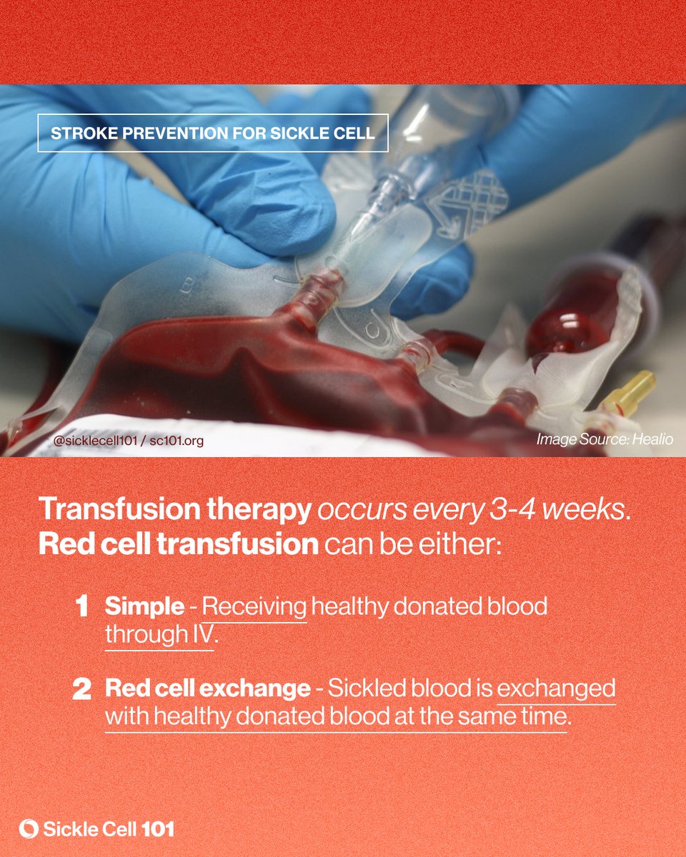 sicklecell101's tweet image. Did you know by the age of 40 years 20% of people who have #sicklecell anemia (SS) have suffered a stroke &amp;amp; 10% of those w/ Hb SC disease have had a stroke?

May is Stroke Awareness Month. Learn more about strokes in sickle cell disease at sc101.org/sicklepedia/st…

#sicklecell101