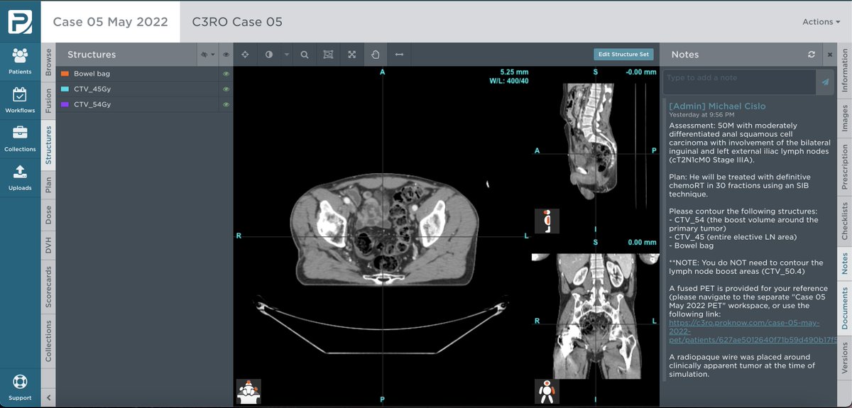 🚨 Excited to announce #C3RO case 5⃣ is NOW OPEN! Contour our GI case today 📅! If you signed up last time, look for our email 📧 in your inbox 📥! If you haven't registered yet, get started here ➡️ econtour.org/c3roRegister Happy contouring! 🎉 #radonc #MedEd