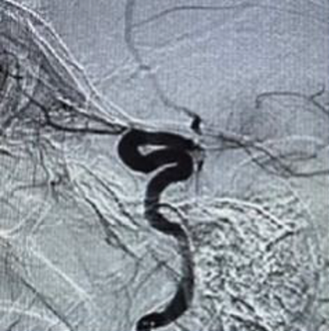 PenNeuro's tweet image. US HCPs: #RED72 case by Dr. Mohamed Teleb (@StrokeVAN) out of Banner Desert Medical Center #REDglideDifference #StrokeAwarenessMonth Rx only. For risk info: bit.ly/37YcYIU. Clinical results may vary.