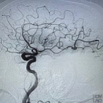 PenNeuro's tweet image. US HCPs: #RED72 case by Dr. Mohamed Teleb (@StrokeVAN) out of Banner Desert Medical Center #REDglideDifference #StrokeAwarenessMonth Rx only. For risk info: bit.ly/37YcYIU. Clinical results may vary.