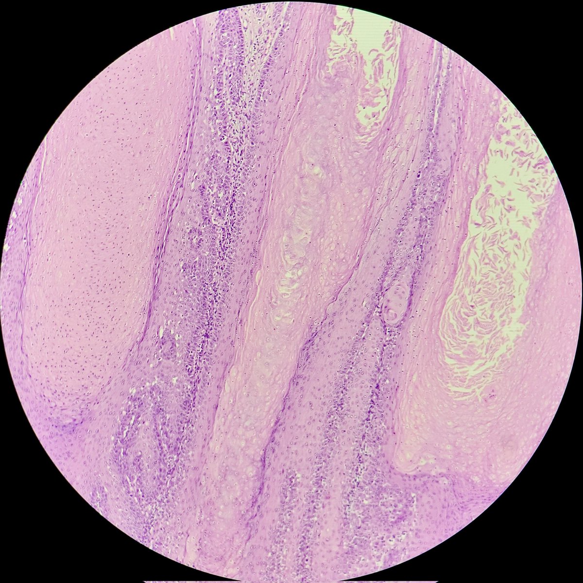 padmapathology1's tweet photo. Vulval lesion - condyloma acuminatum
✴️ Verrucous lesion
✴️ Hyperplastic papillary squamous epithelium
✴️mounds of parakeratosis
✴️ Focal koilocytic change
#gynpath #PathTwitter #grosspath #macromicrocorrelation https://t.co/nTHSK8AF7M
