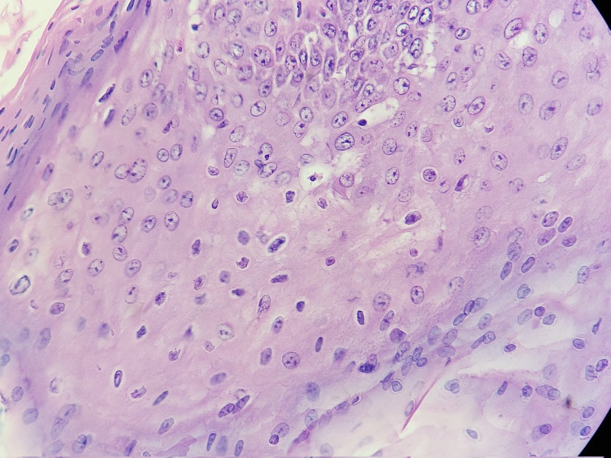 padmapathology1's tweet photo. Vulval lesion - condyloma acuminatum
✴️ Verrucous lesion
✴️ Hyperplastic papillary squamous epithelium
✴️mounds of parakeratosis
✴️ Focal koilocytic change
#gynpath #PathTwitter #grosspath #macromicrocorrelation https://t.co/nTHSK8AF7M