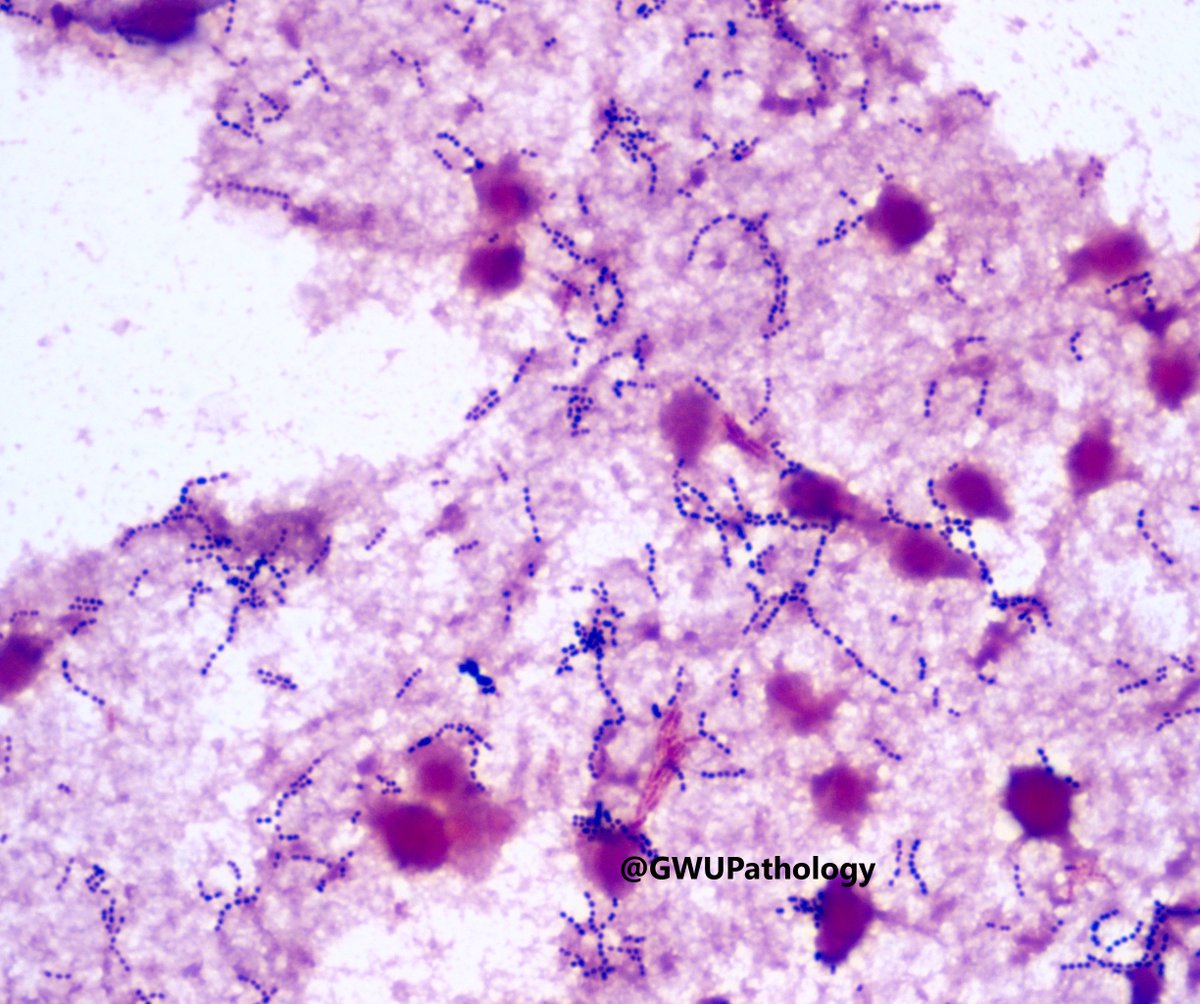 GWPathology's tweet photo. Young man with necrotizing soft tissue infection
Blood culture Gram Stain
Describe the morphology and your differential. What additional confirmatory tests would you order?
Case courtesy of @itsrebeccayee
#PathTwitter #PathResidents #GWPathCOTW #MicroMed #IDTwitter https://t.co/m1fFyP09FV