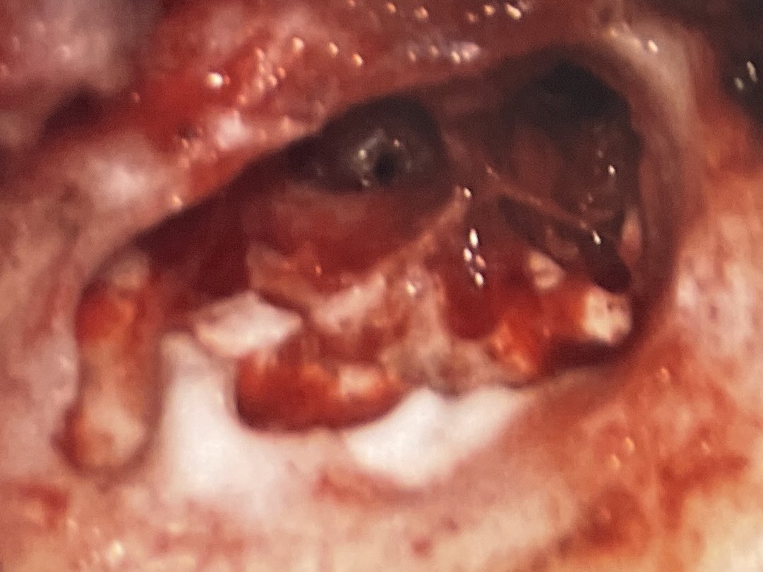 WilliamRBlythe's tweet photo. Cochlear implant after previous Esteem implant. Other than a bit of cement in various places, it wasn’t that bad!
#ENTwitter #GeneralENT https://t.co/FJdOuDK7oW
