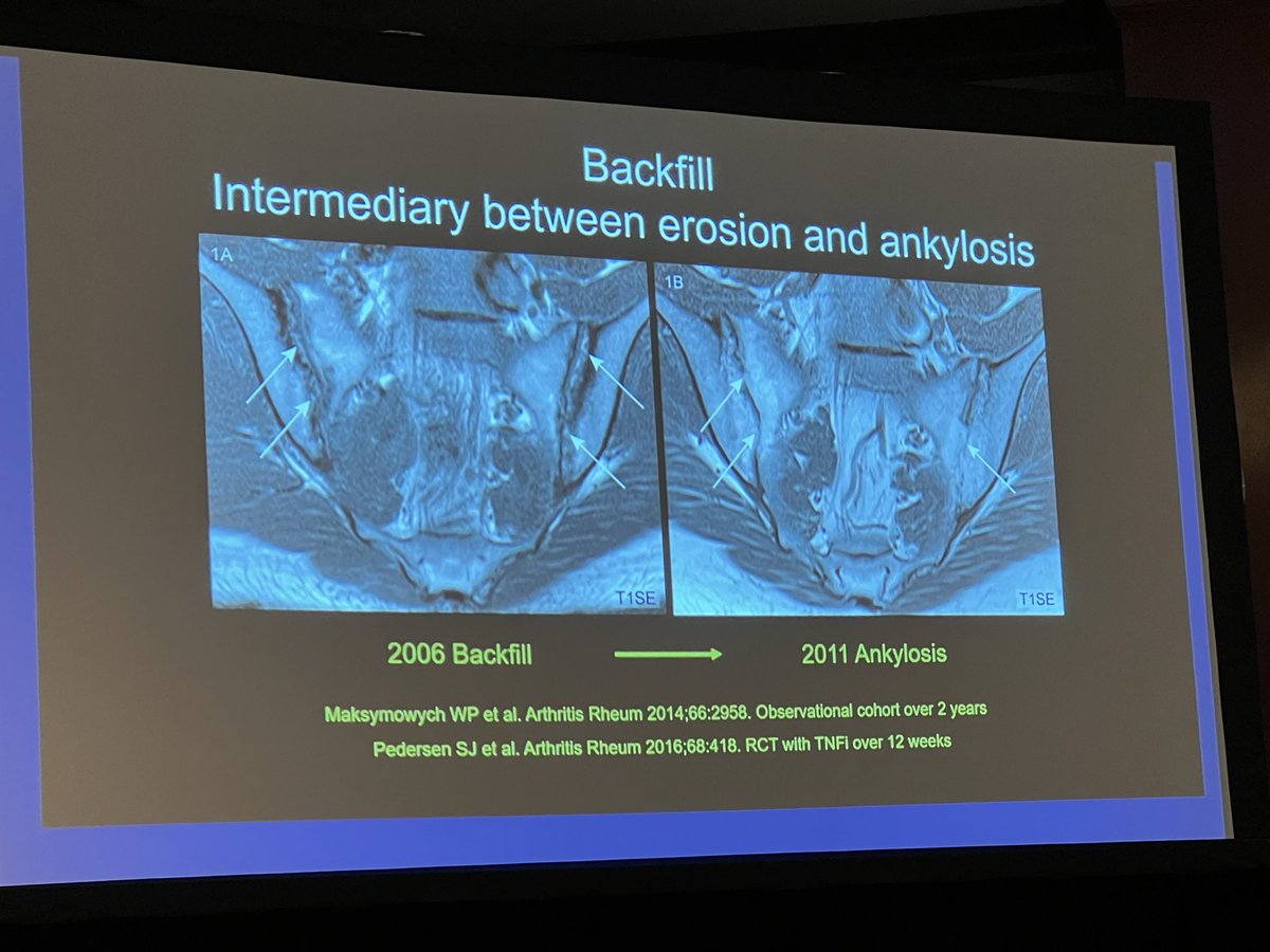 The_ASSR's tweet photo. Imaging findings of SpA from Dr. John Carrino 

#SNRXXII #ASNR22 @JackASSR23 @LubdhaShah @KSeifertMD @radiology_ninja @OrmsbyMD https://t.co/8OawVAkbbn