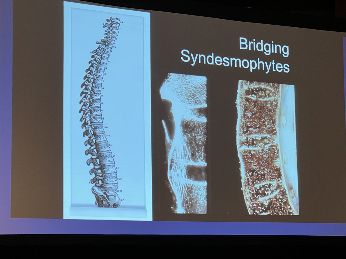 The_ASSR's tweet photo. Imaging findings of SpA from Dr. John Carrino 

#SNRXXII #ASNR22 @JackASSR23 @LubdhaShah @KSeifertMD @radiology_ninja @OrmsbyMD https://t.co/8OawVAkbbn
