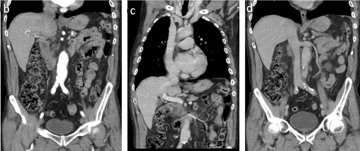 SERAM_RX's tweet photo. Valor del mapa #Vascular #Arterial en la cirugía del #CáncerColorrectal

🔎Los autores del #PiperSERAM de la semana evalúan el papel del #AngioTC en la cirugía de este #Cáncer con preservación de la #Arteria cólica izquierda

¡No te lo pierdas!▶️https://t.co/jXMXuOtJHF https://t.co/olXsXvoOhj