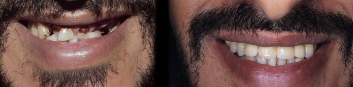 thamer_1418's tweet photo. ( ١٠ خلع , ٨ علاج عصب , ٨ حشوات , 
٦ اوتاد , جراحتين لثه تطويل التاج , ٩ تلبيسات )
اكثر من ٥٠ موعد
 هذا ما تطلبه الأمر مني لإنهاء إعادة تأهيل شامل لهذه الاسنان .. ابتسامة مريضي استحقت تعب الشهور الاخيرة كلها 🦷
لَم يكُن الأمر سهلاً لكنّني فعلتها👨🏻‍🎓🖤 @dent_batch17 #infinites2022 https://t.co/yGJs48KLW7