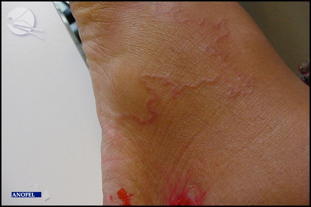 EAnofel's tweet photo. 🪱 Picture of the day: Cutaneous larva migrans (also known as creeping disease). The disease is caused by zoonotic hookworm species (such as Ancylostoma caninum or A. braziliense). Migrating larvae cause pruritis and erythematous serpiginous tracks. #eanofel #hookworm #MedTwitter https://t.co/kq0cRUiinM