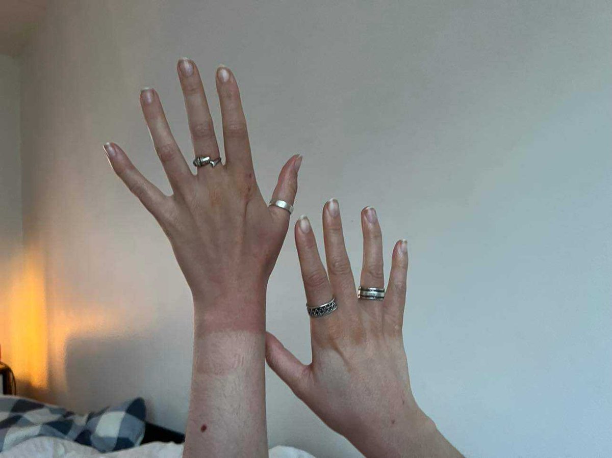 Oops. Wrist splint tan.