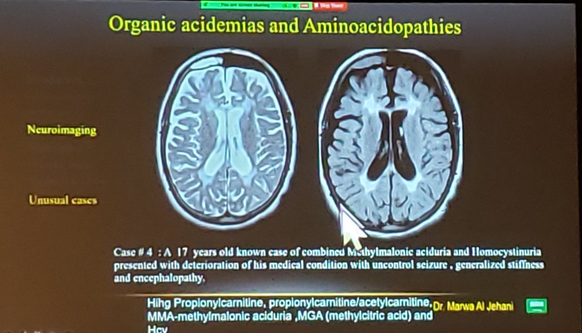 Fab_Neuroradio's tweet photo. Super comprehensive presentation on metabolic diseases in children by Dr. @AmnaKashgari
#ASNR22
@TheASNR @The_ASPNR https://t.co/qz68oovsFu