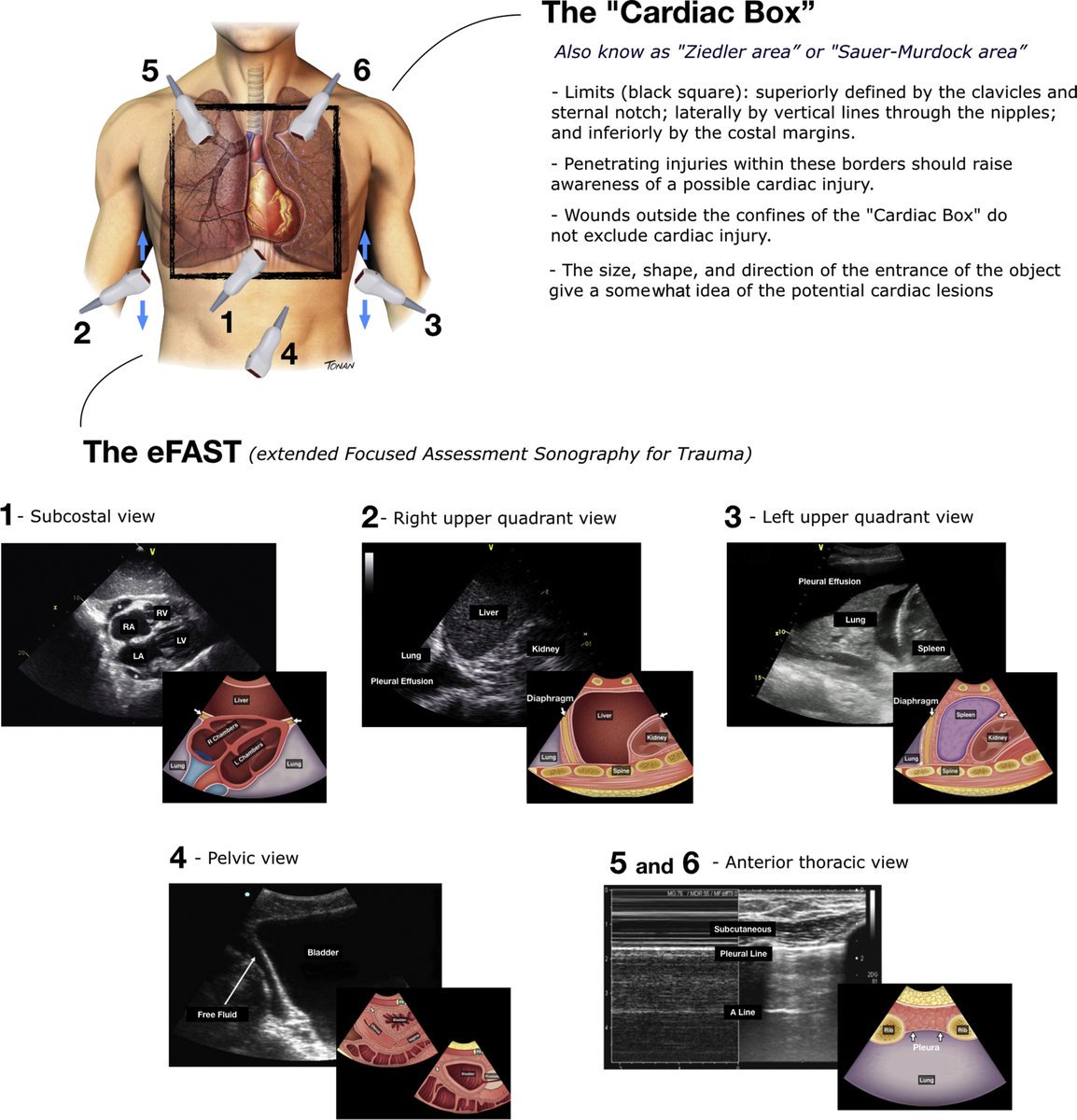 NephroP's tweet photo. Illustration of the cardiac box and eFAST #POCUS windows.
#Trauma #MedEd 
🔗https://t.co/YRH6nCoPnO https://t.co/Num48JhSVa