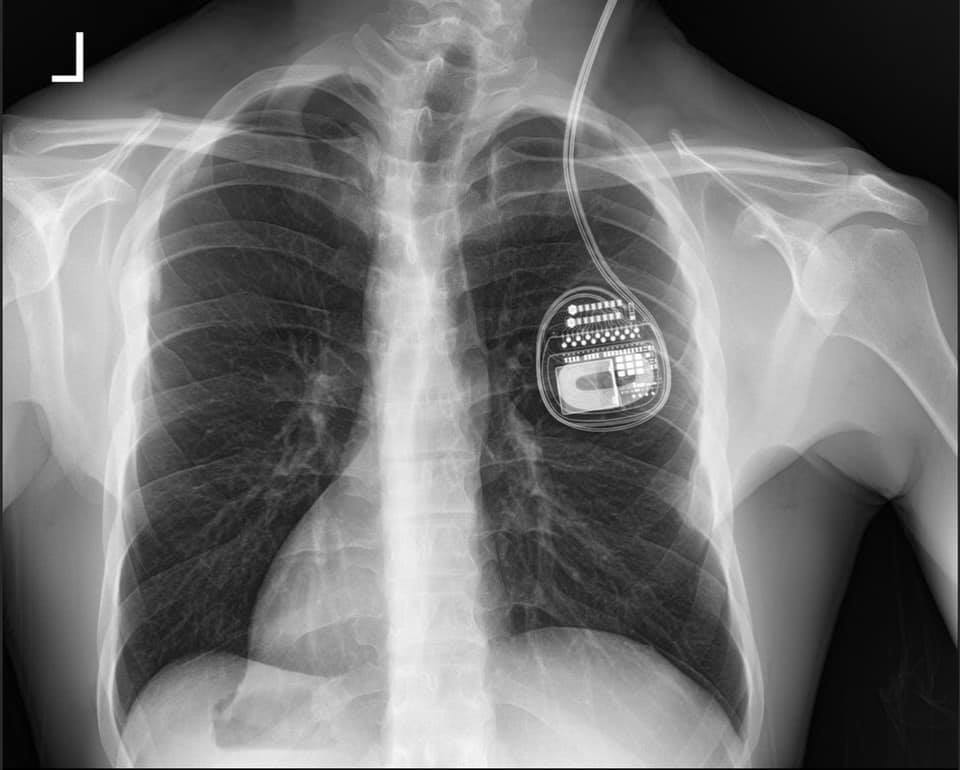 BSmuda's tweet photo. Bring 'em out 
Bring 'em out 
Bring 'em out

Soon I'll be live from the OR
Slice me open 6 but no more
Replace the old implant with double what I got
80 staples to the head babe you know it's hot
Pack up my pecks with twice the juice
Gonna be 24V yo time to get loose! https://t.co/aAjLrusxV0