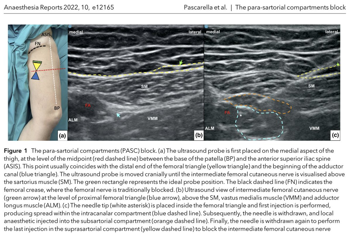 Dr Pascarella et al describe the para-sartorial compartments (PASC) block for anterior knee analgesia. 

<a href="/PascarellaDr/">Dr Giuseppe Pascarella</a> <a href="/Alestrumia/">alestrumia</a> 

Keen to try this three-step RA technique for your next TKR? 

Read about it here 👉…-publications.onlinelibrary.wiley.com/doi/full/10.10…