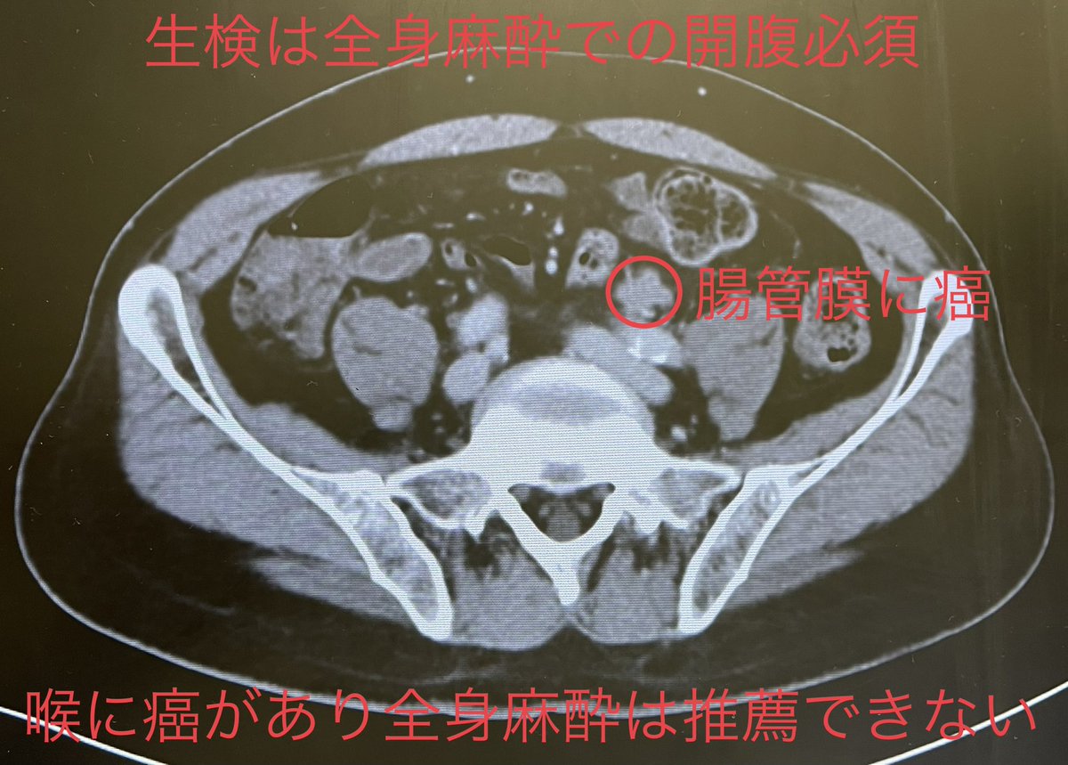 Mutoh_Z's tweet photo. @z_mutoh 喉頭蓋近くの癌に加え、
腸管膜にも癌があり 生検が難しいので、
喉頭蓋近くの癌(形質細胞腫が原発)に対する抗がん剤治療を開始し、
3ヶ月後に再度CT(造影剤)を取り小さくなってなければ、リスクを承知で開腹での生検を行い 新たな治療方針を決定する様です😰
取り敢えず、5/24の週に入院する事に…😇 https://t.co/hEdSSYlZ7J