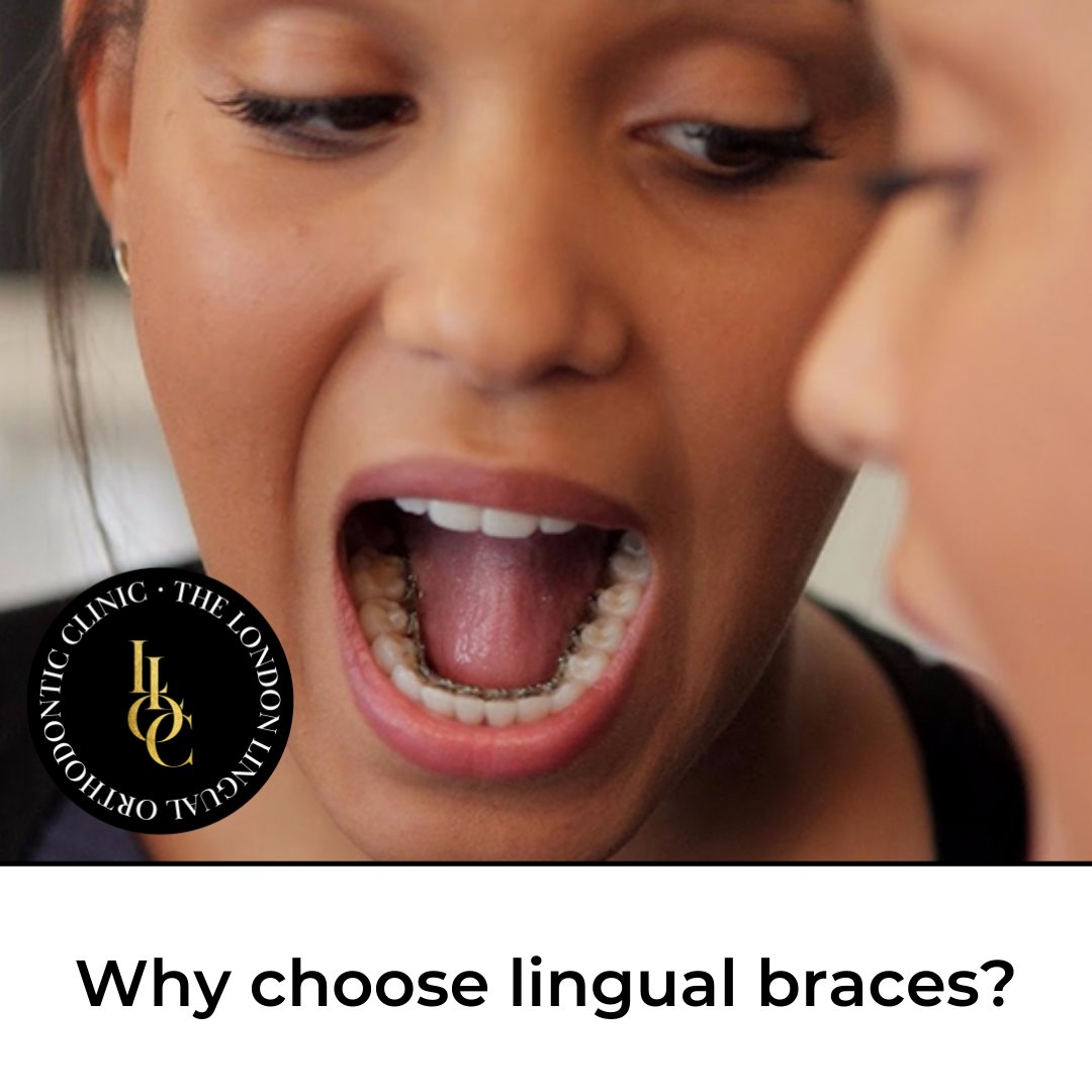 Aside from discreet treatment, the main advantages of #lingualbraces are that they are:

⚫Suitable for many people
⚫Just as effective at straightening simple problems as they are for more complex issues
⚫ Adjustable throughout treatment to achieve more precise results