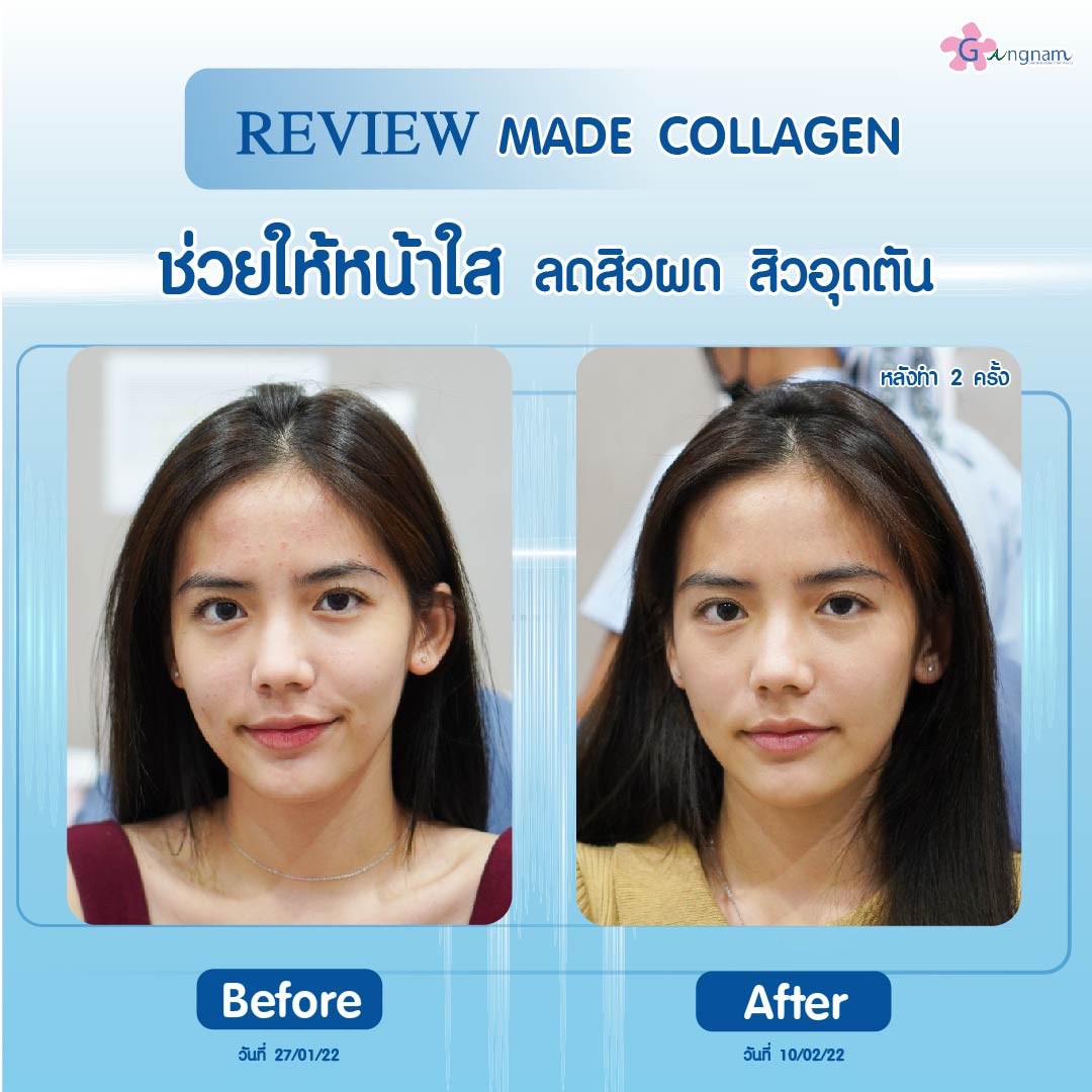 GangnamclinicT's tweet photo. ทางลัดของการฟื้นบำรุงผิวที่ล้ำลึกจากภายใน
กระตุ้นเซลล์ผิวแข็งแรง พร้อมเผยผิวสวยใส
ด้วย  Made Collagen 💖 สร้างผลลัพธ์สุดว้าวให้ผิวหน้าของคุณ 

สนใจสอบถาม-จองคิว ทักหาออนนี่ได้ที่ Line ID : @gangnamclinic

#ฉีดมาเด้ #MadeCollagen #GangnamClinic #OriginalfromKorea #กังนัมคลินิก https://t.co/hY9JhaAVDV